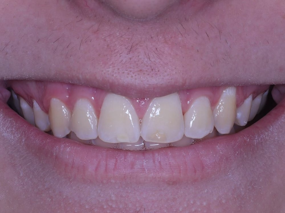 Antes — Clareamento dental