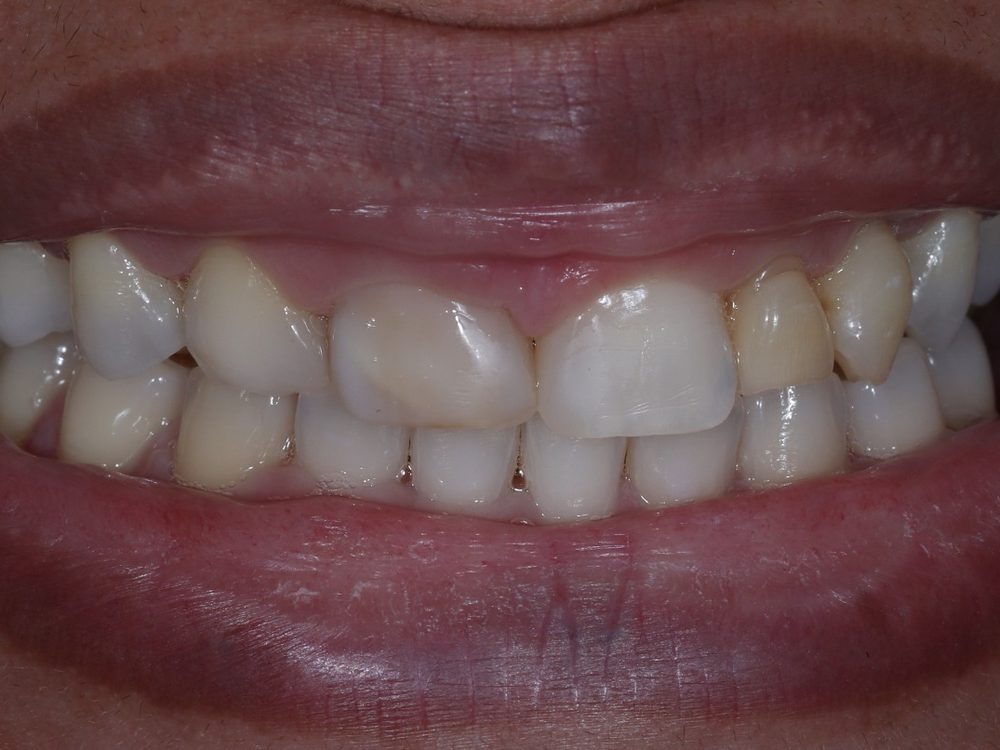 Antes — Facetas em resina