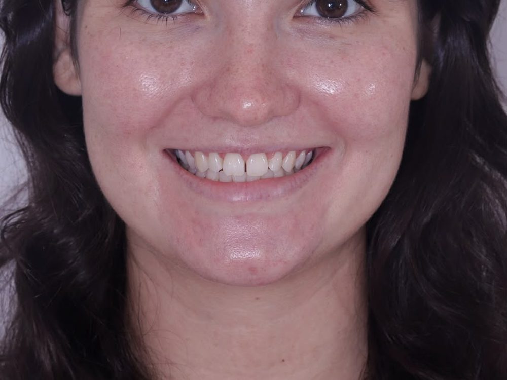 Antes — Facetas em resina