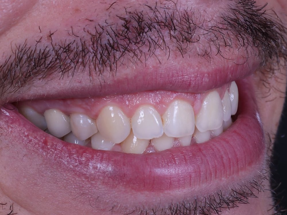Antes — Cirurgia de Gengivectomia