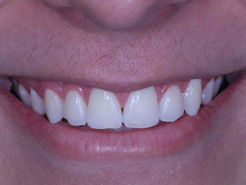 Depois — Clareamento dental