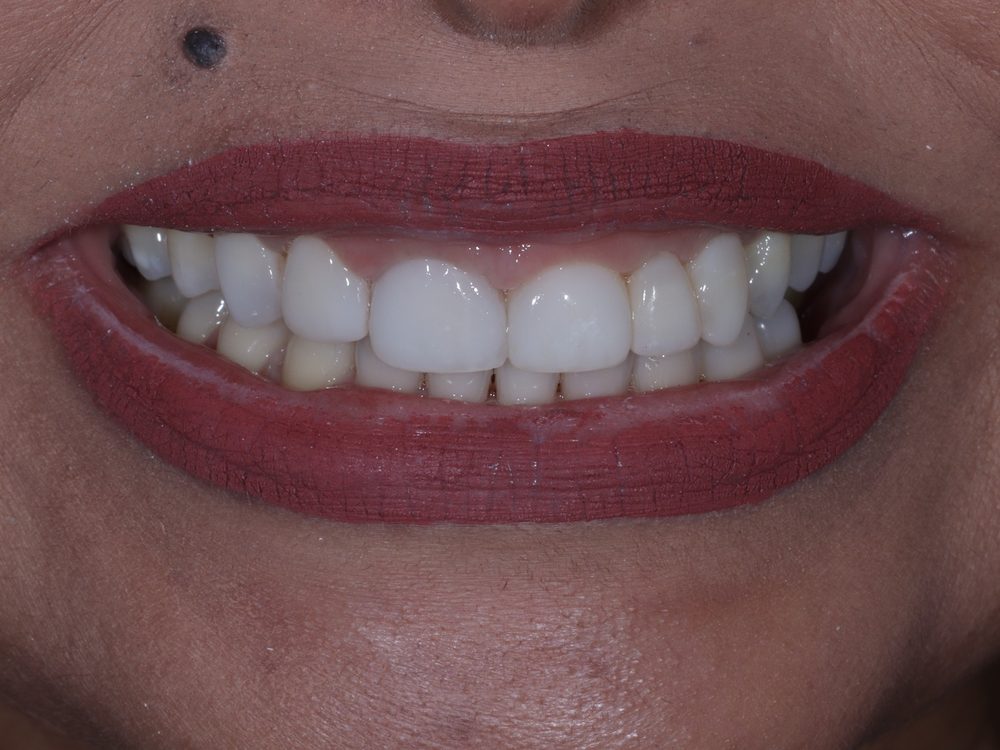 Depois — Facetas em resina