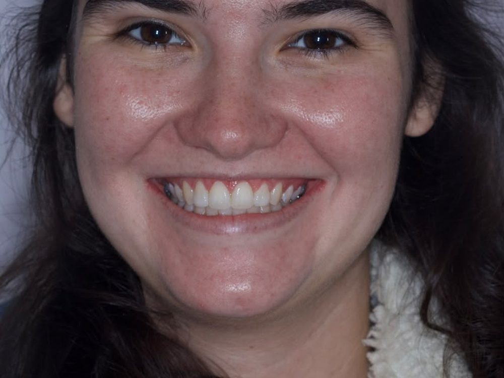 Depois — Facetas em resina
