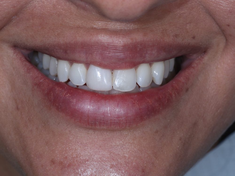 Depois — Facetas em resina