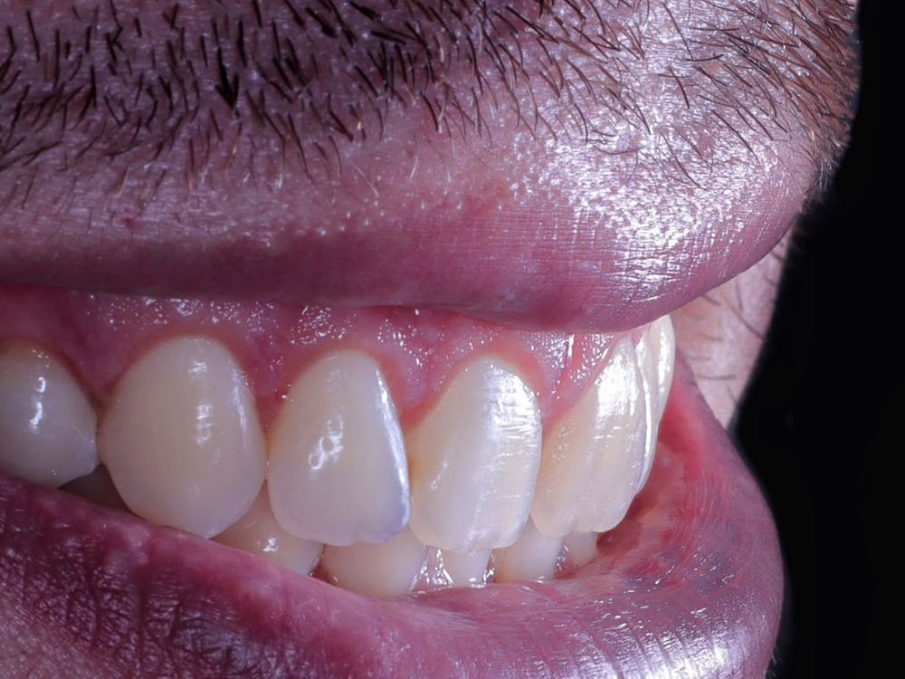 Depois — Cirurgia de Gengivectomia